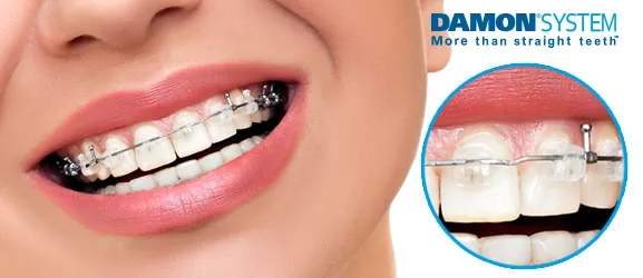 Braces-Damon